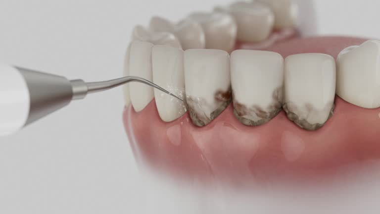 Trusted Wisdom Tooth Removal service in Stonecrest, GA - Dentist Open Now
